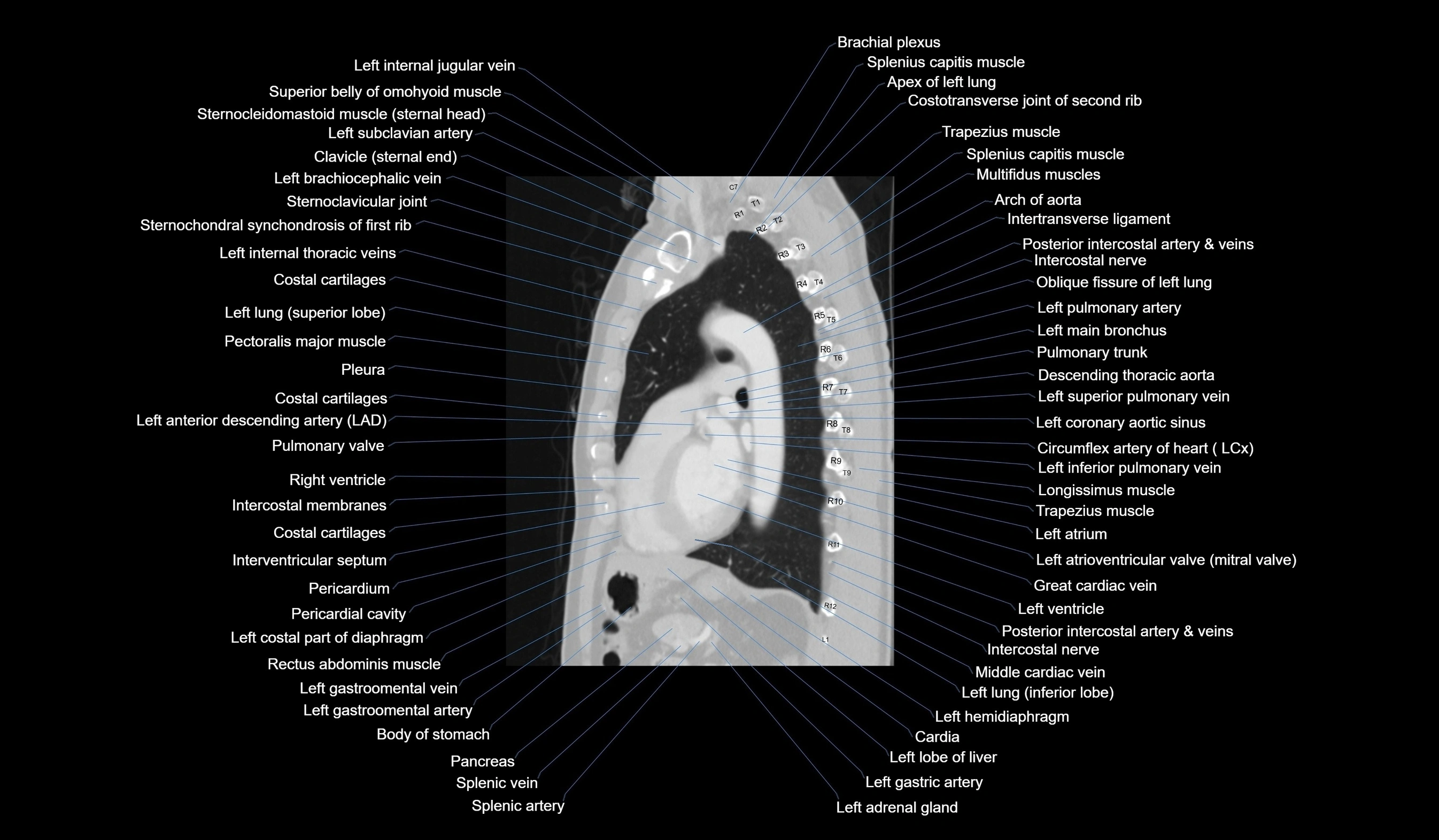 CT chest (thorax) labelled sagittal cross sectional anatomy radiology image-00086.webp